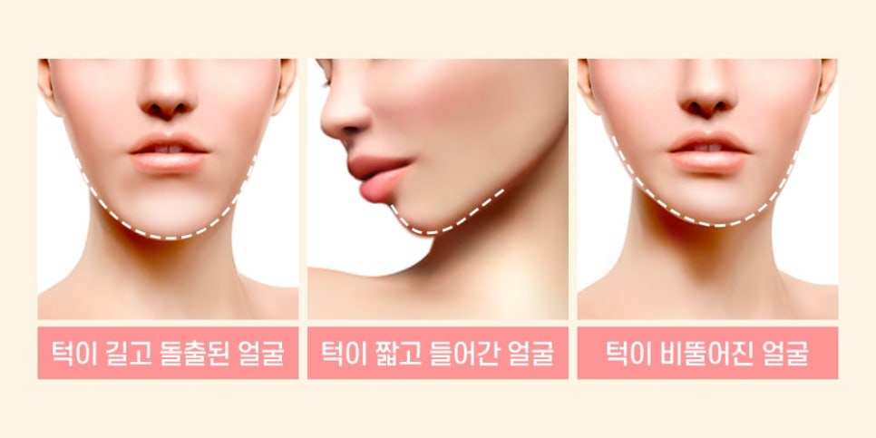 앞턱 수술, 얼굴형과 조화를 이루는 턱 선이 작은 얼굴을 결정짓는다. 관련 이미지 2