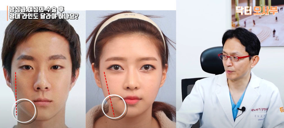 남성, 여성의 윤곽 수술 차이점이 있을까? 관련 이미지 7