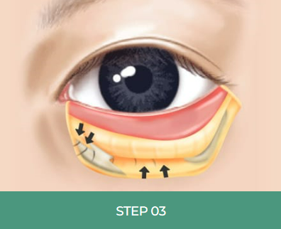눈 밑 주름, 다크서클 눈 밑 지방재배치로 개선할 수 있습니다. 관련 이미지 6