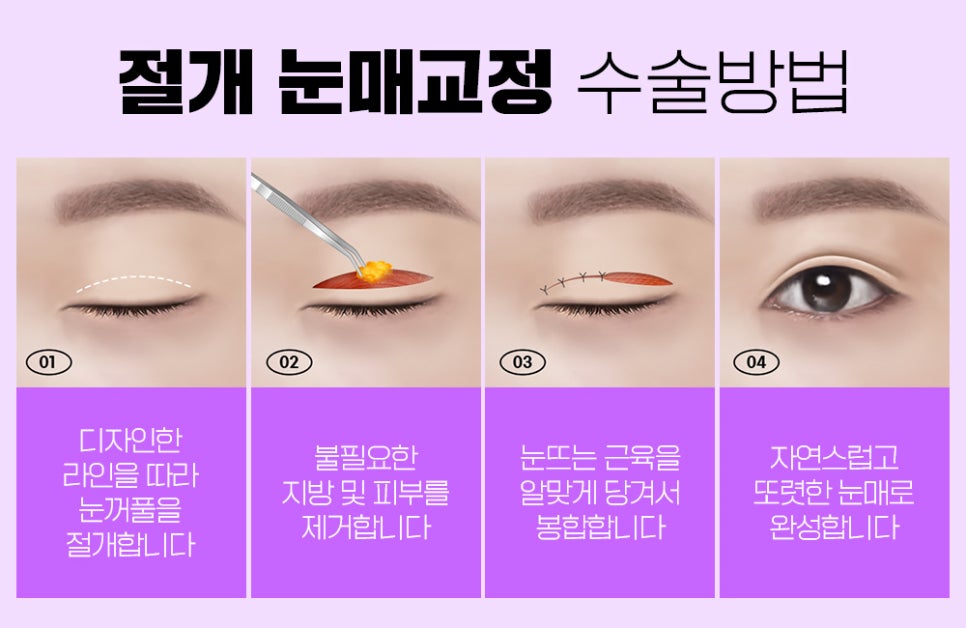 눈매교정 나에게 맞는 수술법으로 확실하게 개선하자 관련 이미지 4