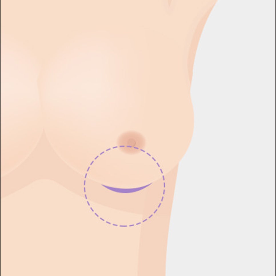 가슴 성형, 보형물의 종류와 절개법의 장단점 관련 이미지 13