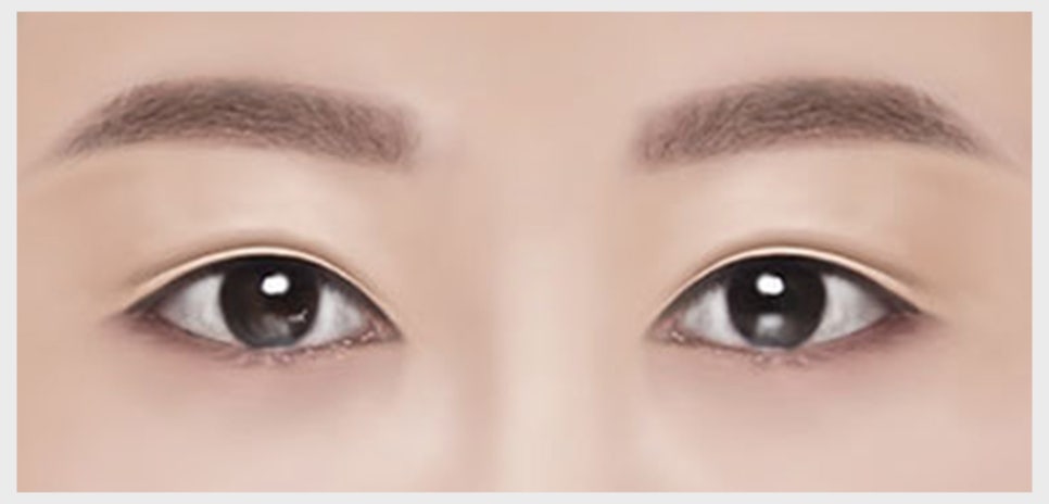 쌍꺼풀 재수술이 필요한 유형과 원인에 맞는 재수술 방법 관련 이미지 7