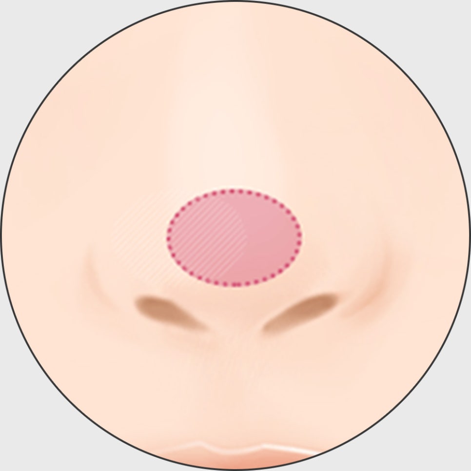 코 재수술, 적합한 시기에 원인에 따른 올바른 방법으로 개선해야 합니다! 관련 이미지 5