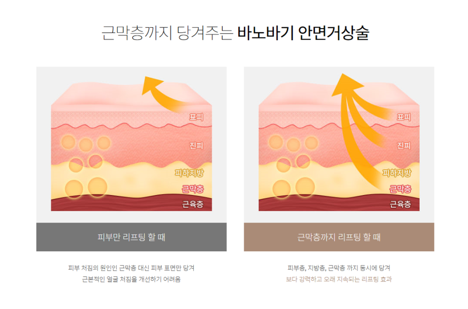 어떤 동안 성형보다 효과가 뛰어난 안면거상술 관련 이미지 9