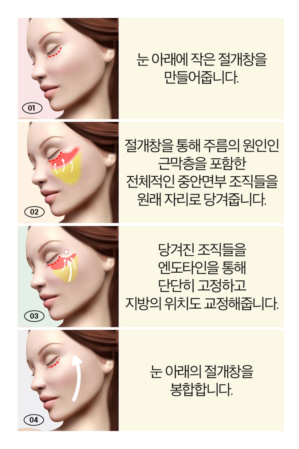눈 밑, 팔자 주름 동시에 개선하는 중안면부 리프팅 관련 이미지 3