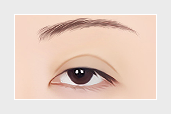 눈 재수술, 미세한 변화로도 달라질 수 있습니다. 관련 이미지 5