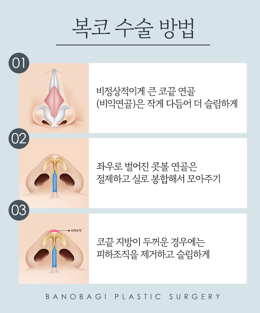 남자 코성형, 코 라인에 따라 달라지는 수술 방법 관련 이미지 7