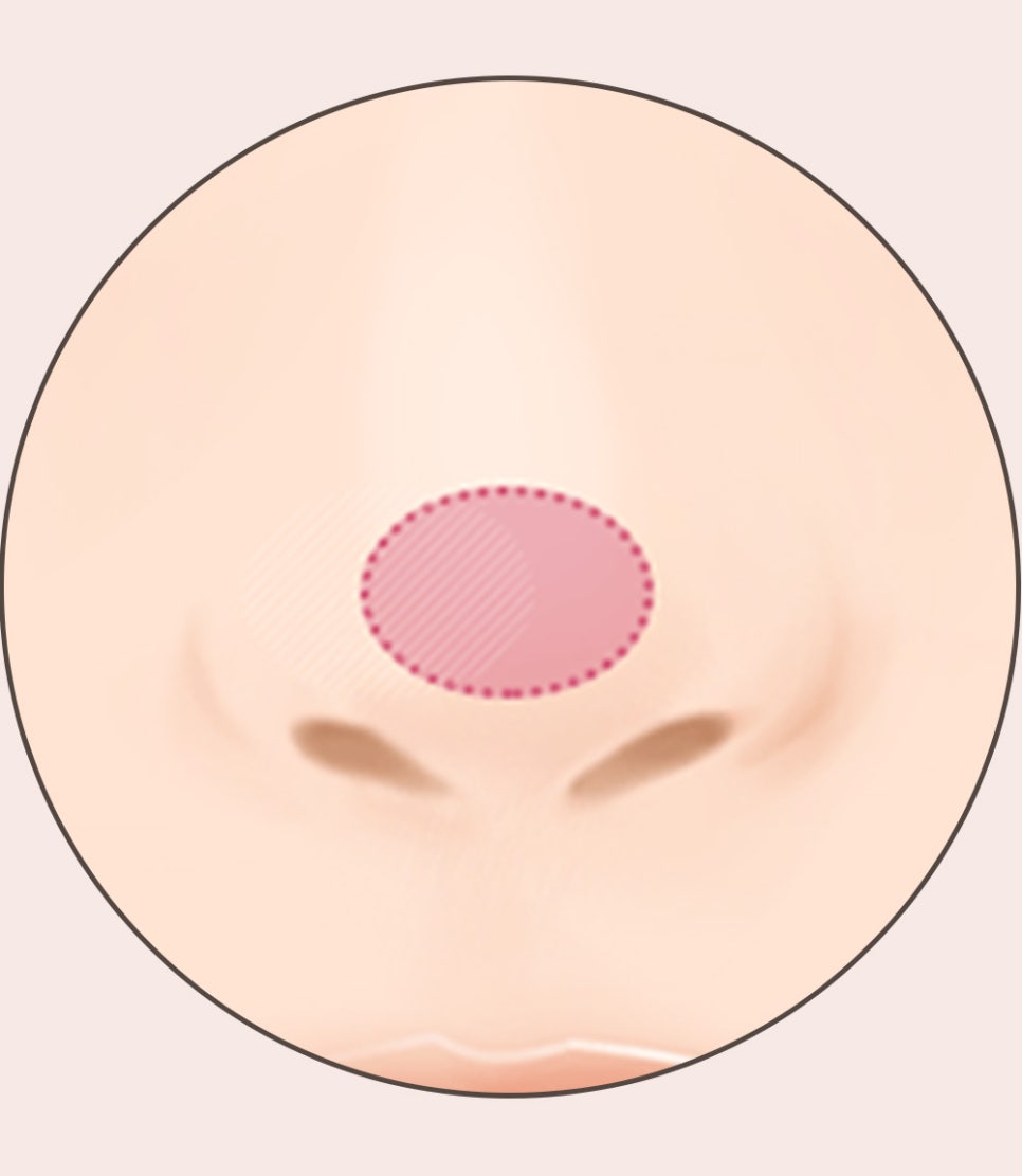 코 재수술의 다양한 원인과 개선 방법! 관련 이미지 7