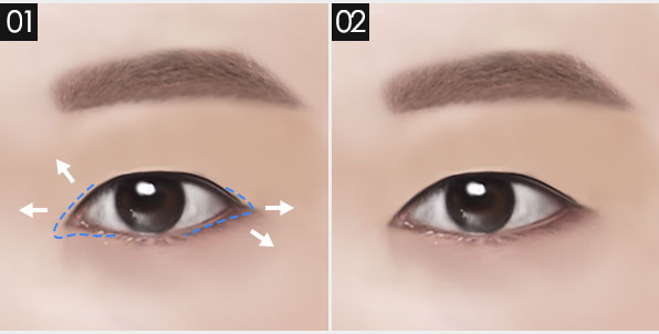 남자 눈 성형, 자연스럽고 또렷한 인상으로! 관련 이미지 6