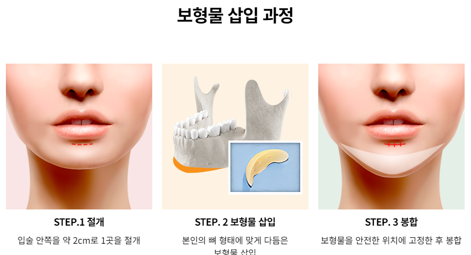 입체감 있고 또렷한 윤곽 라인의 비결은? 보형물 앞턱수술 관련 이미지 3