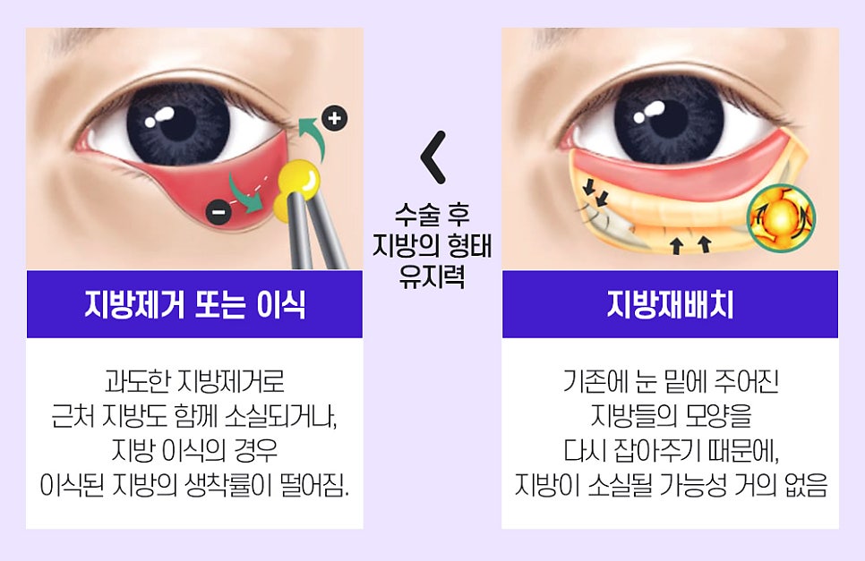 볼록한 눈 밑, 다크서클 한 번에 개선하는 눈밑지방재배치 관련 이미지 5