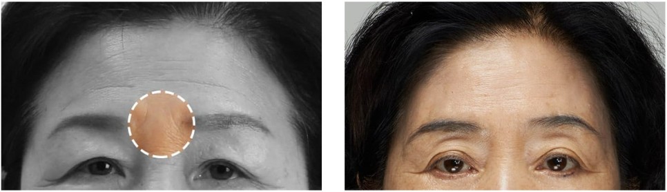 내시경 엔도타인 이마 리프팅으로 더욱 밝아지는 인상! 관련 이미지 4