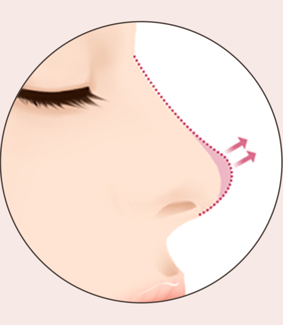 코 재수술의 다양한 원인과 개선 방법! 관련 이미지 5