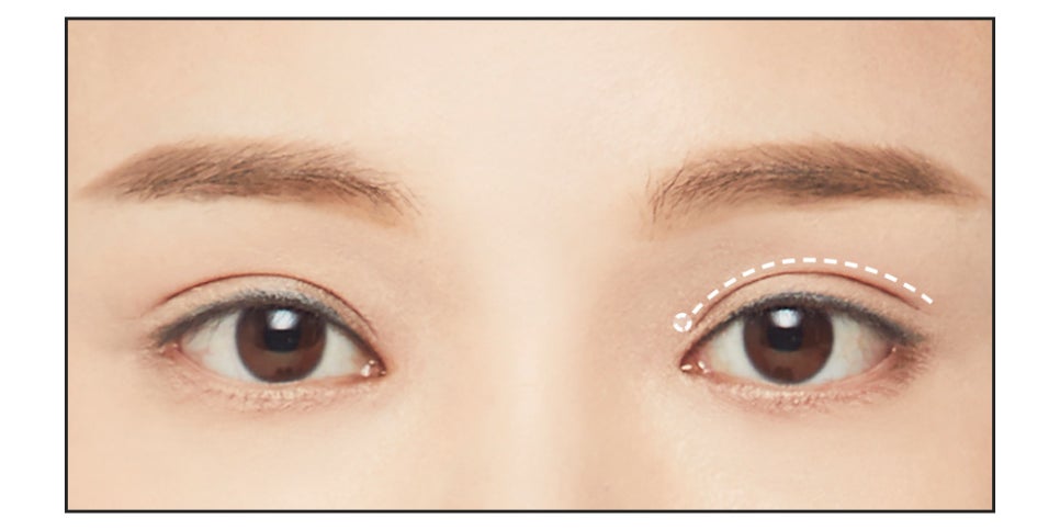 절개 쌍꺼풀의 수술법과 절개법이 필요한 경우 관련 이미지 6