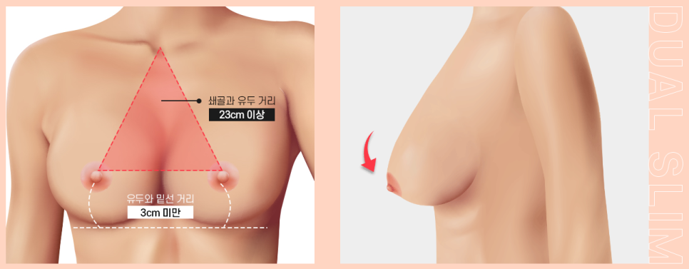 상체 지방흡입과 가슴 축소의 날씬한 조합! 듀얼슬림 관련 이미지 2