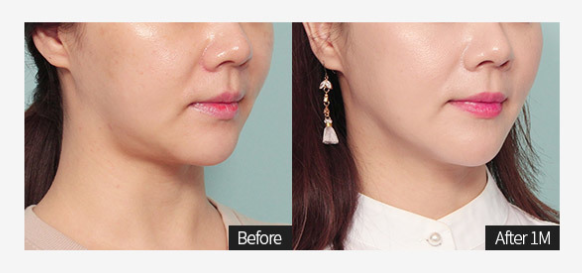 이중턱지방흡입과 민트실리프팅을 한번에 하면 그 효과는? 관련 이미지 4