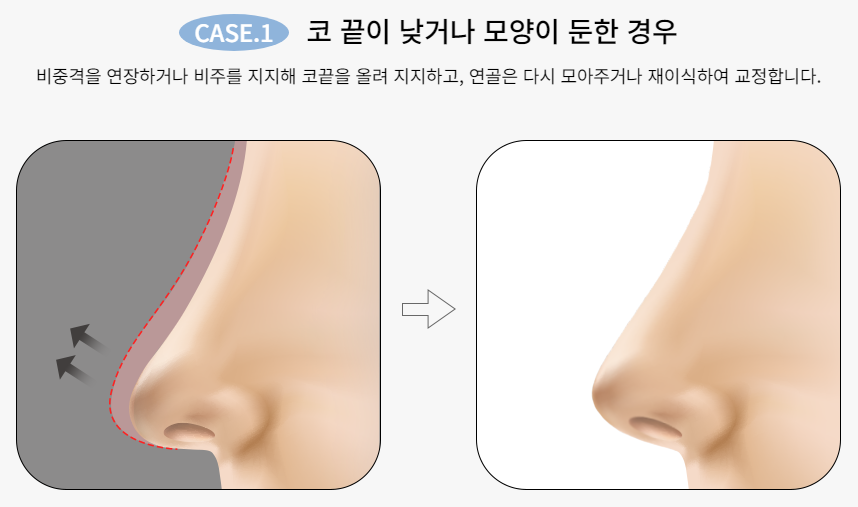 마지막 코재수술, 바노바기에서! 관련 이미지 3