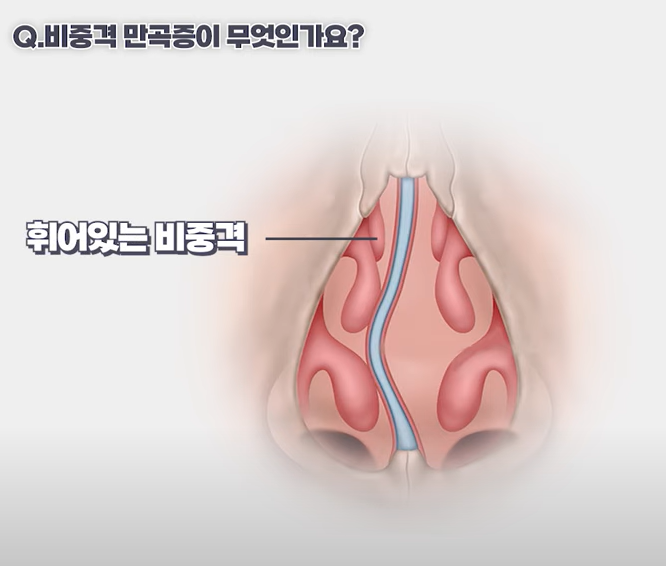 코막힘의 원인! 비중격 만곡증에 대해서 알려드립니다. 관련 이미지 2