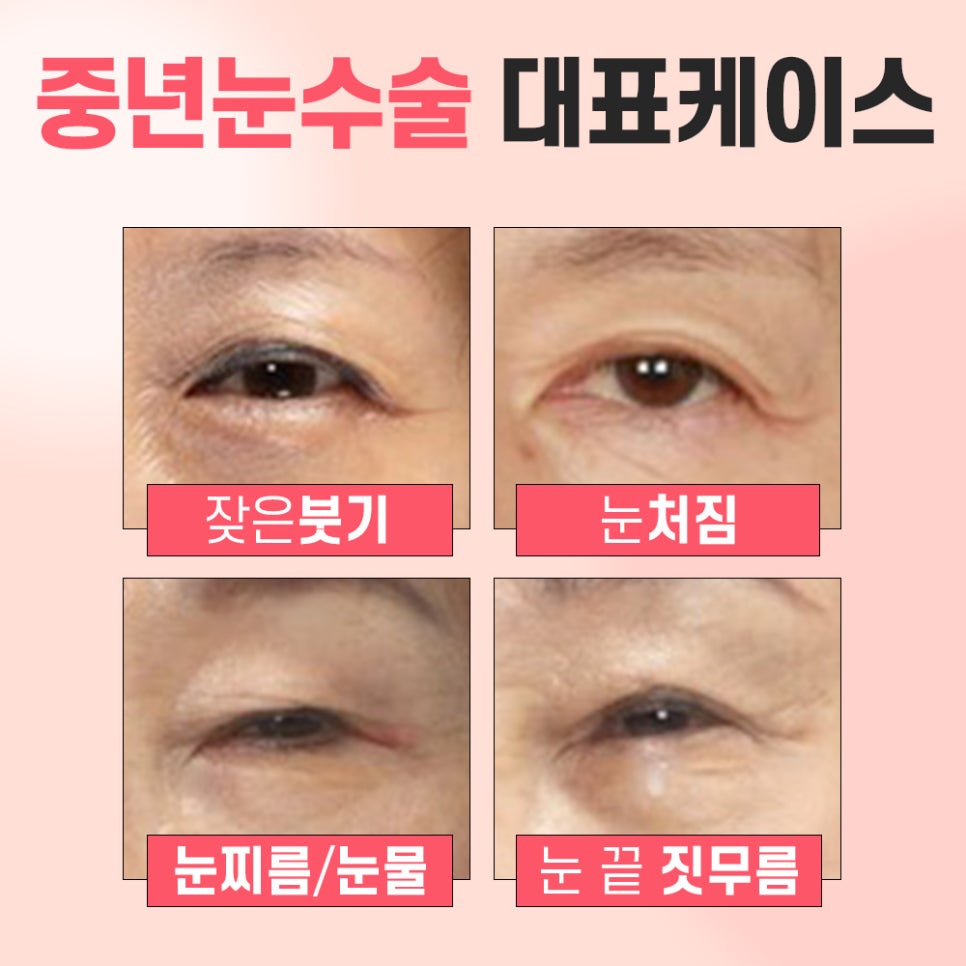 중년 눈꺼풀 처짐은 상안검 수술을 통해 개선 할 수 있습니다. 관련 이미지 2