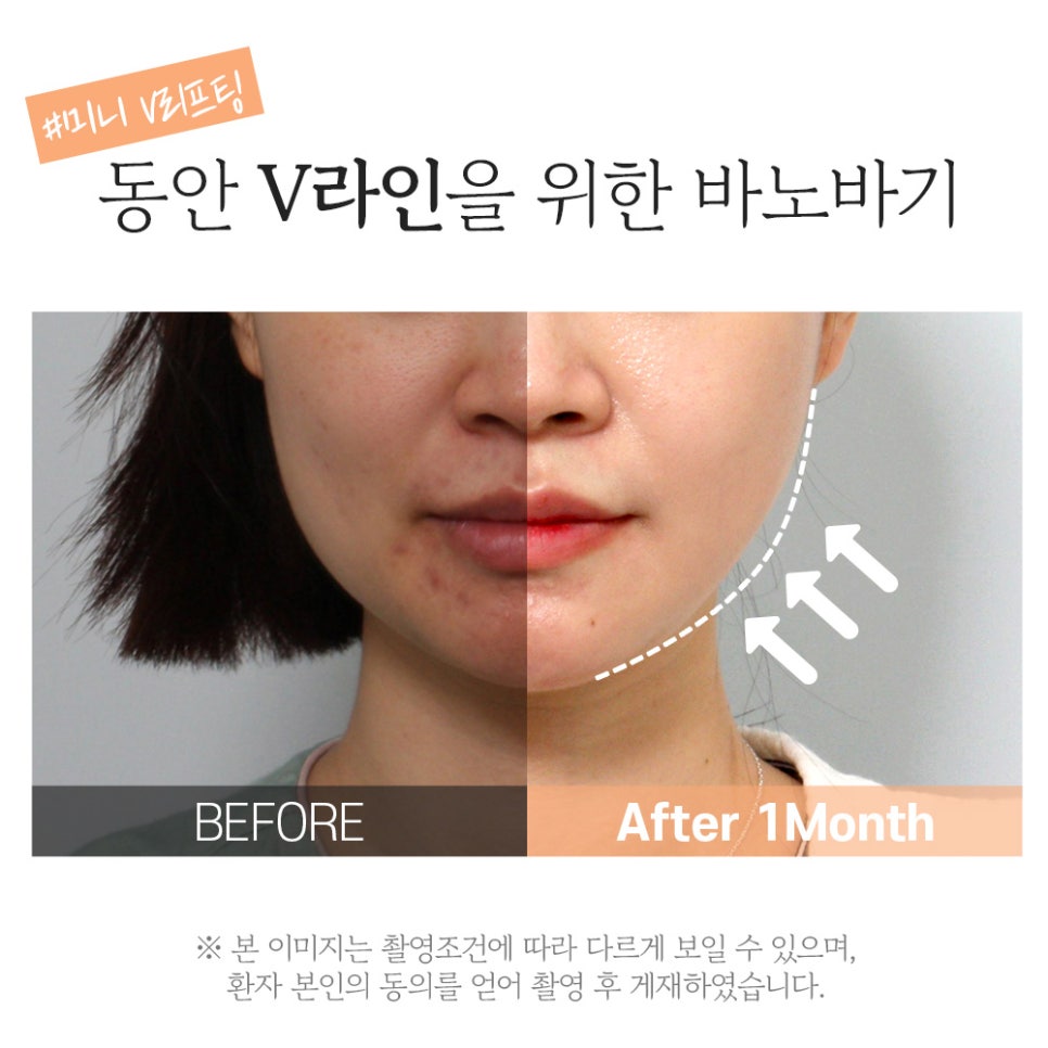 피부 탄력, 이중턱, 주름 한 번에 개선하는 미니V리프팅 관련 이미지 8