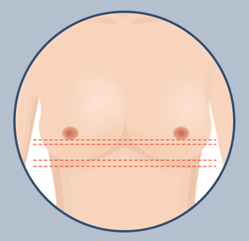 가슴 재수술, 원인에 맞는 정확한 수술법과 후 관리가 중요한 이유! 관련 이미지 5
