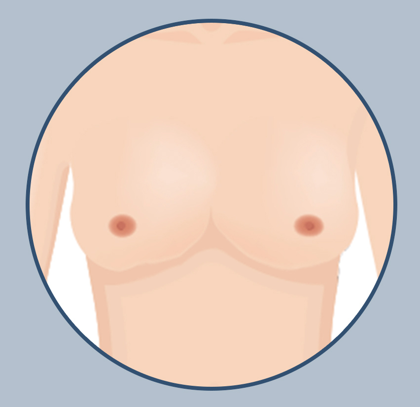 가슴 재수술, 원인에 맞는 정확한 수술법과 후 관리가 중요한 이유! 관련 이미지 3