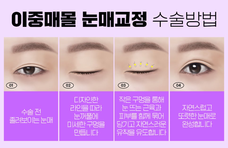눈매교정 나에게 맞는 수술법으로 확실하게 개선하자 관련 이미지 3
