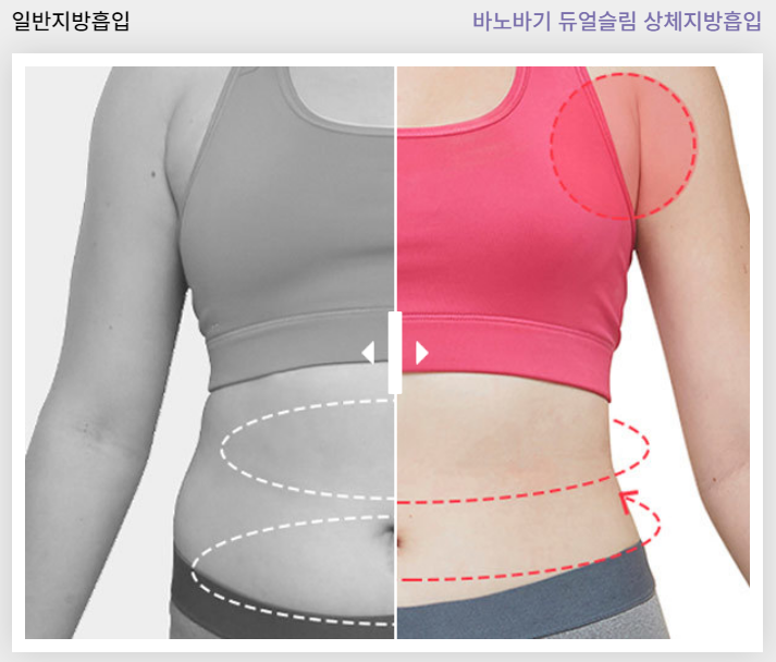 신체 균형을 위한 가슴 축소술! 관련 이미지 4