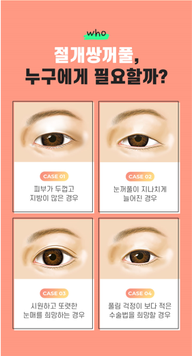 절개가 오히려 자연스러울 수 있다? 바노바기 쌍꺼풀수술 알아보기! 관련 이미지 3