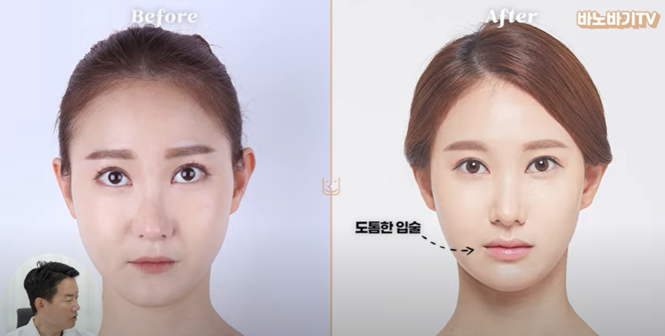 아테콜 필러의 장점과 아테콜 추천 부위는?! 관련 이미지 9