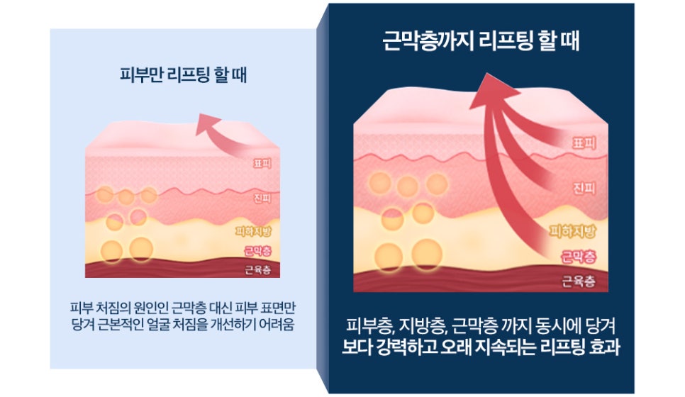 근막층까지 확실하게 당기는 바노바기 하안면부거상 관련 이미지 4