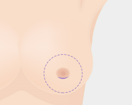 가슴 확대술, 최적의 보형물로 아름다운 가슴 형태를 만들어야 합니다. 관련 이미지 8