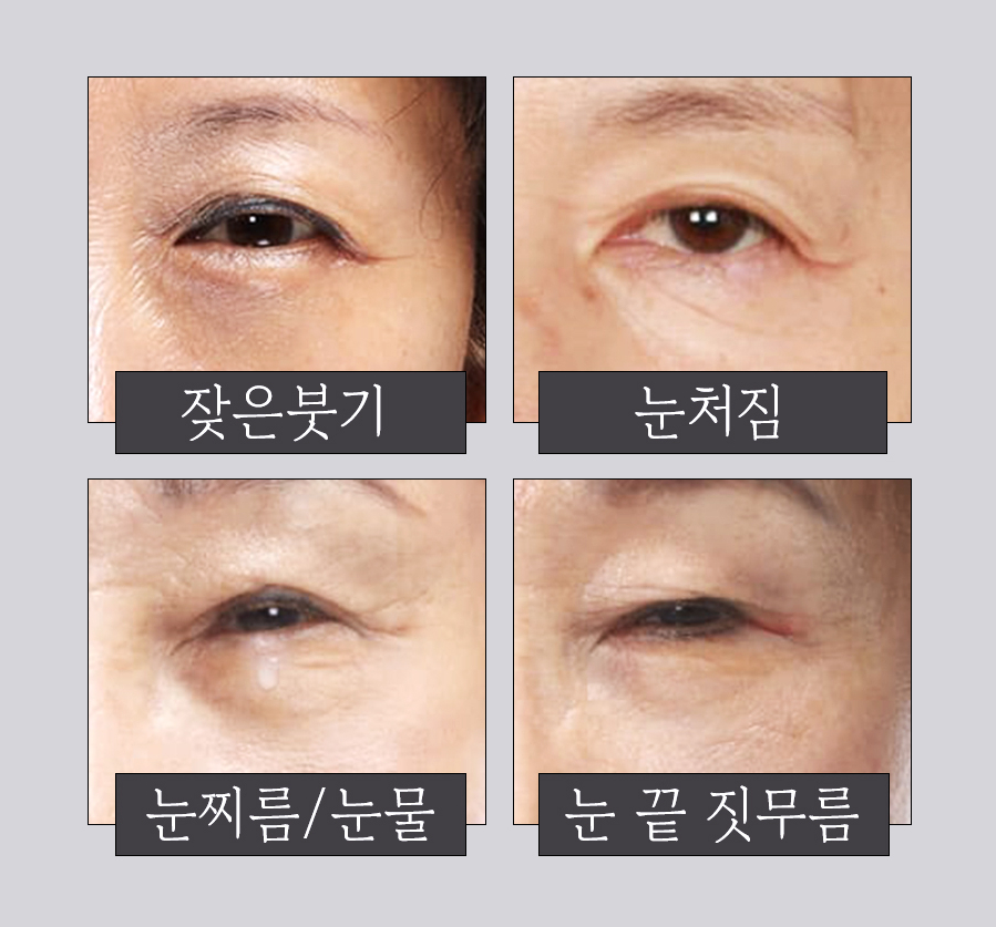 상안검, 미용적 기능적 문제 동시에 개선해 동안 눈매로 관련 이미지 2