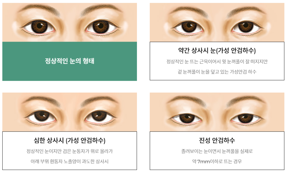 눈매교정잘하는병원 바노바기는 확실합니다. 관련 이미지 3