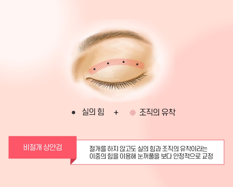 중년 눈꺼풀 처짐은 상안검 수술을 통해 개선 할 수 있습니다. 관련 이미지 4