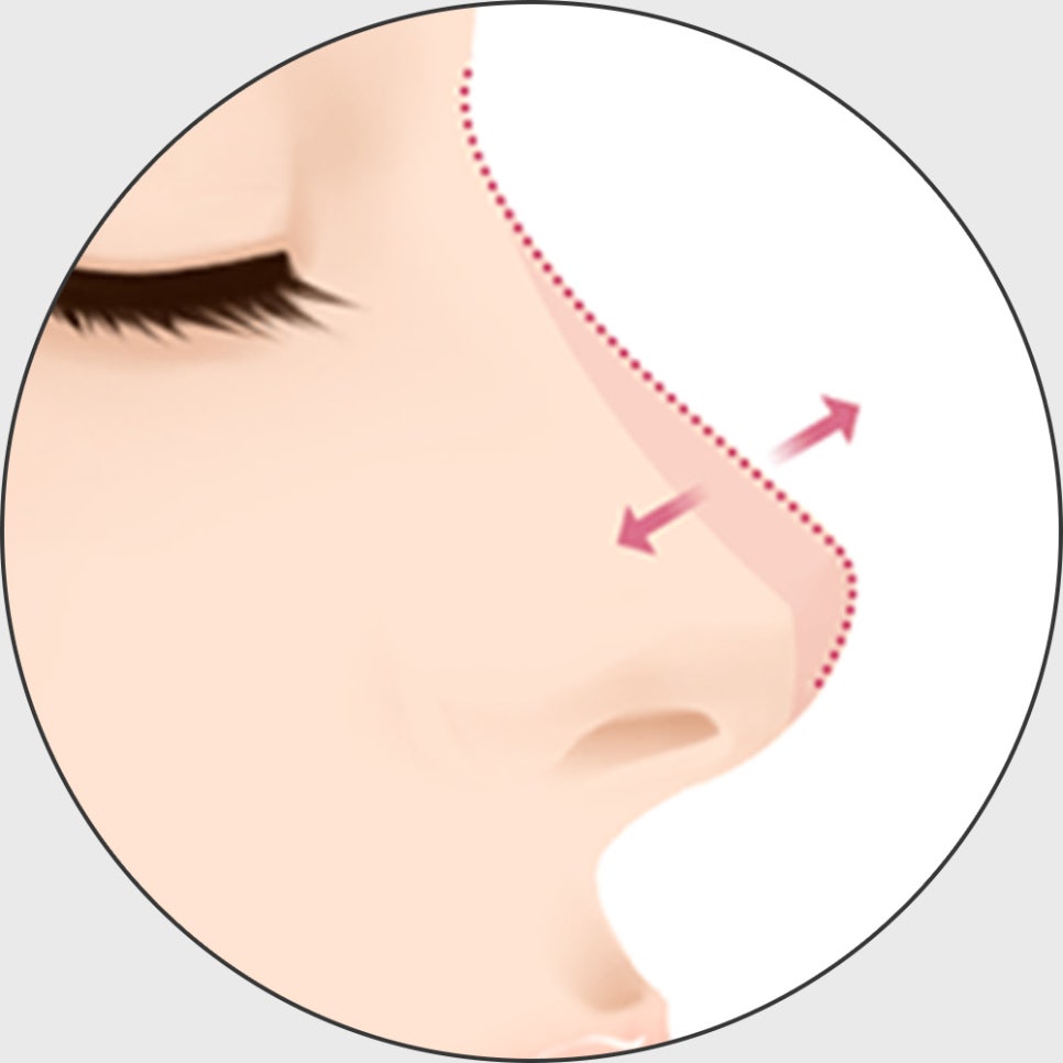 코 재수술, 적합한 시기에 원인에 따른 올바른 방법으로 개선해야 합니다! 관련 이미지 6