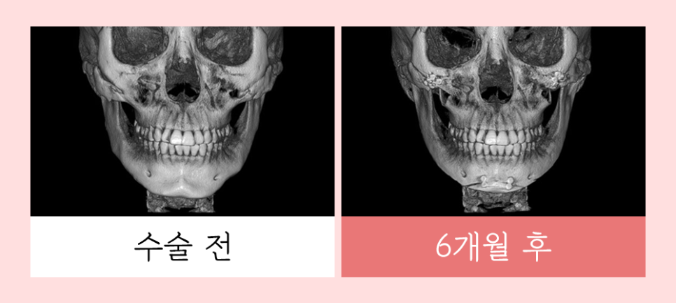 윤곽 재수술의 다양한 원인과 개선 방법! 관련 이미지 3