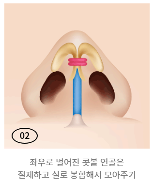 통통하고 뭉툭한 코, 슬림하고 오똑하게! 복코 성형 관련 이미지 4