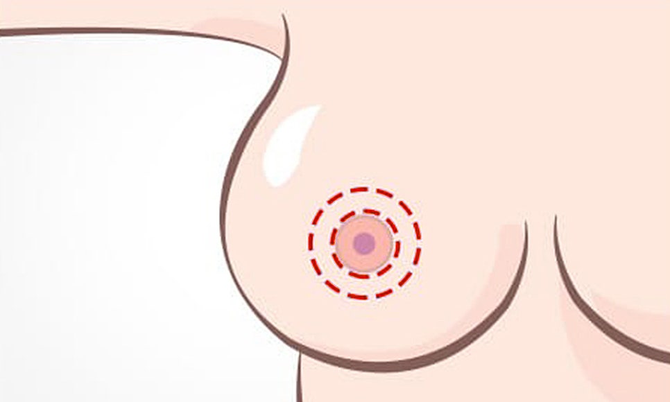 처진 가슴, 케이스에 따른 맞춤 개선으로 탄력 있고 볼륨감 있는 가슴으로! 관련 이미지 4