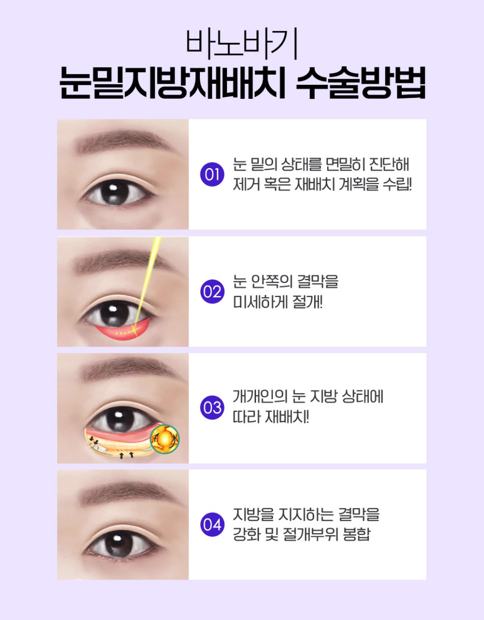 볼록한 눈 밑, 다크서클 한 번에 개선하는 눈밑지방재배치 관련 이미지 4