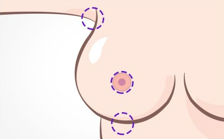 가슴처짐수술 회복과 흉터에 더욱 신경 써야 합니다. 관련 이미지 6