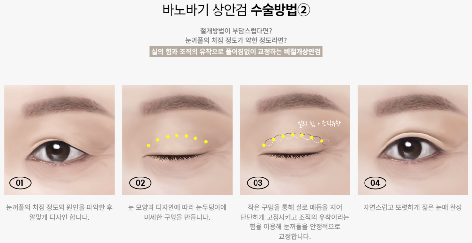 미용적+기능적 문제를 동시에 개선하다, 상안검/하안검 관련 이미지 4