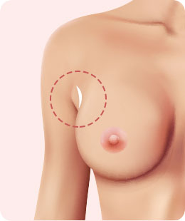 여의사 가슴 성형, 상담부터 수술까지 1:1 맞춤 케어 관련 이미지 7