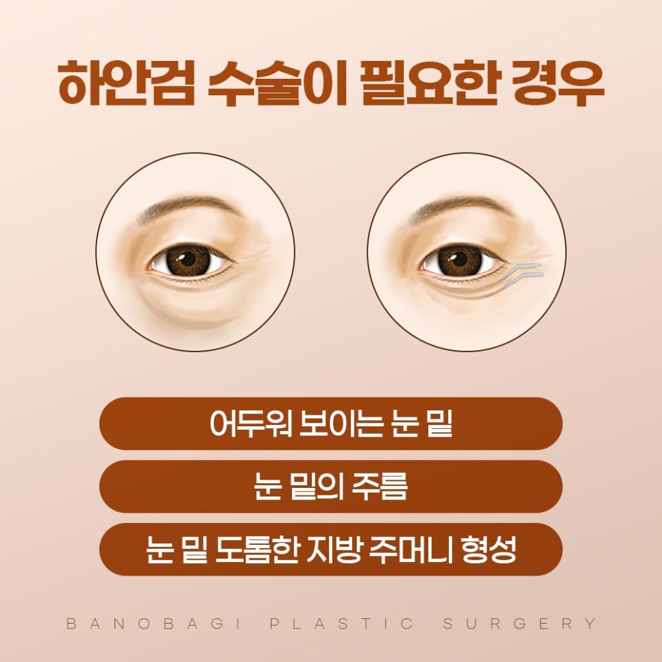 하안검 수술, 자연스럽고 밝아지는 인상으로 개선 하실 수 있습니다. 관련 이미지 2
