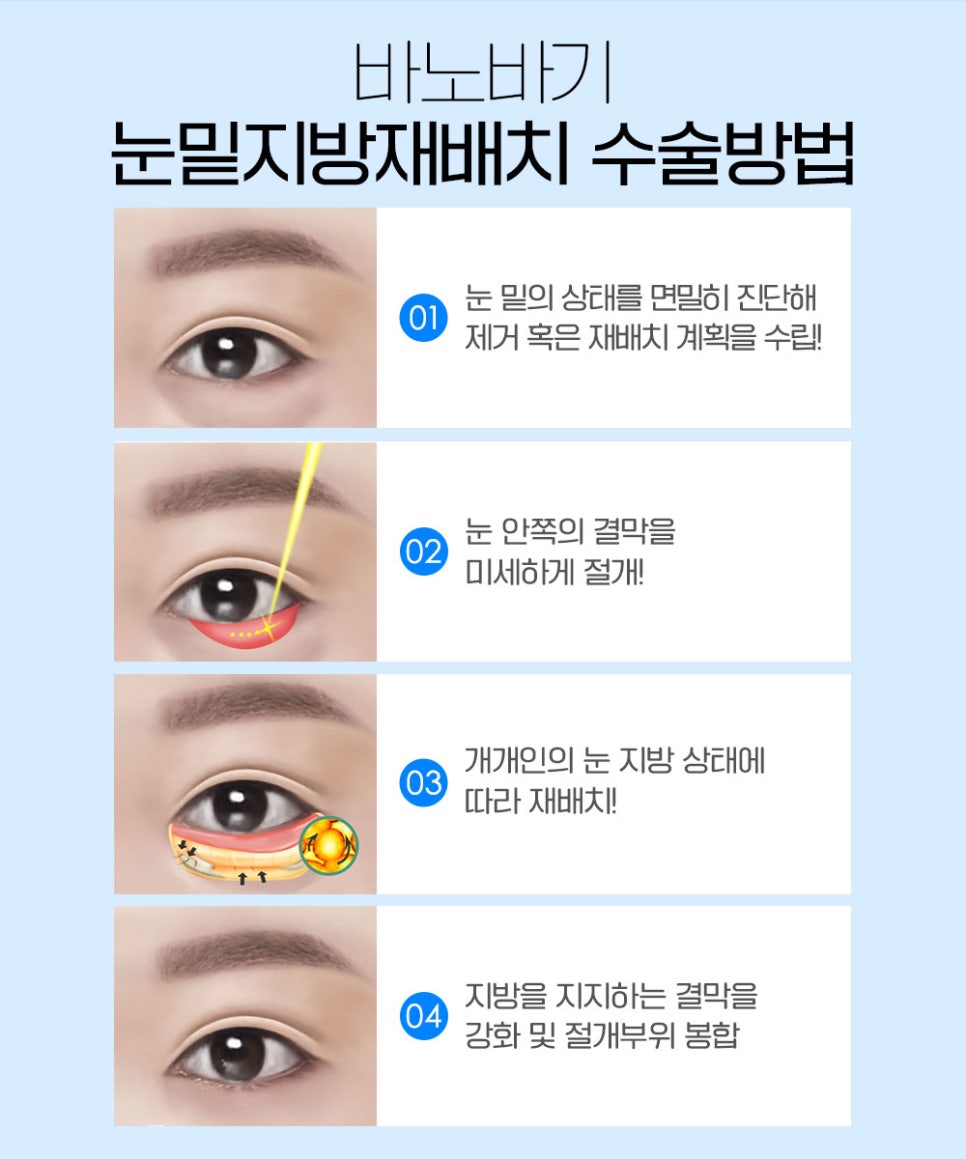 눈밑 지방재배치, 볼록하고 어두운 눈가를 환하게 개선 관련 이미지 6