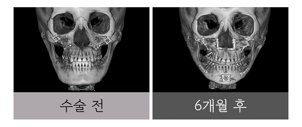 윤곽 재수술, 정밀한 진단과 치밀한 설계로 바로잡아야 합니다. 관련 이미지 5