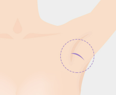 가슴 확대술, 최적의 보형물로 아름다운 가슴 형태를 만들어야 합니다. 관련 이미지 6