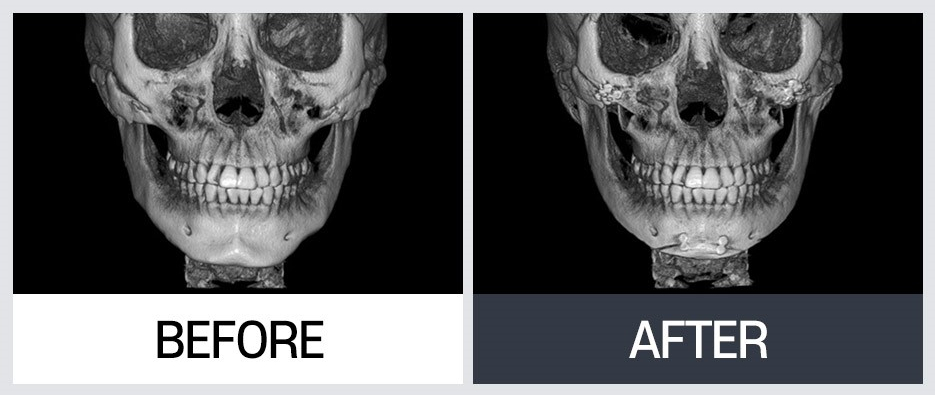윤곽 재수술의 다양한 케이스와 수술 방법 관련 이미지 5