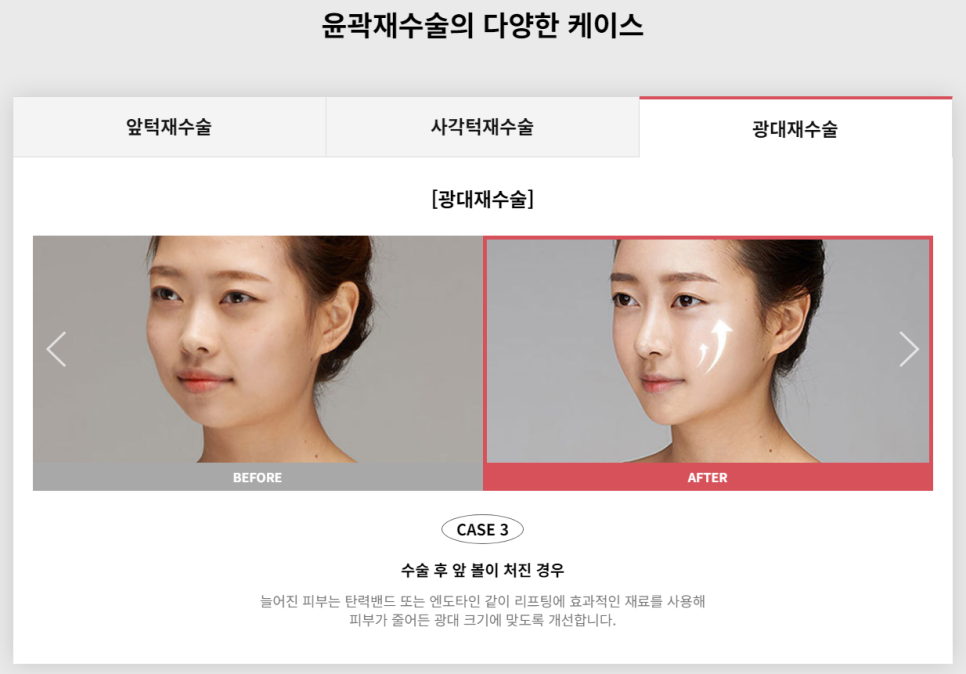 다시 되찾는 아름다운 미소! 윤곽재수술 관련 이미지 9