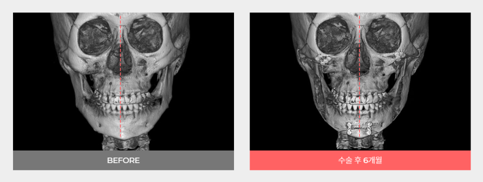 안면윤곽재수술 정답은 바노바기입니다! 관련 이미지 5